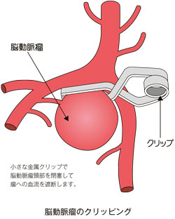 イラスト:脳動脈瘤のクリッピング